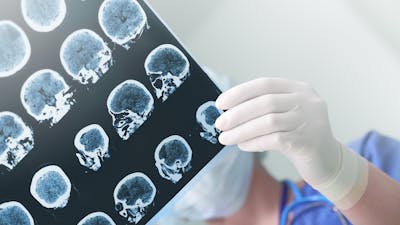 The ketogenic diet for Alzheimer's prevention and treatment: Can it help?